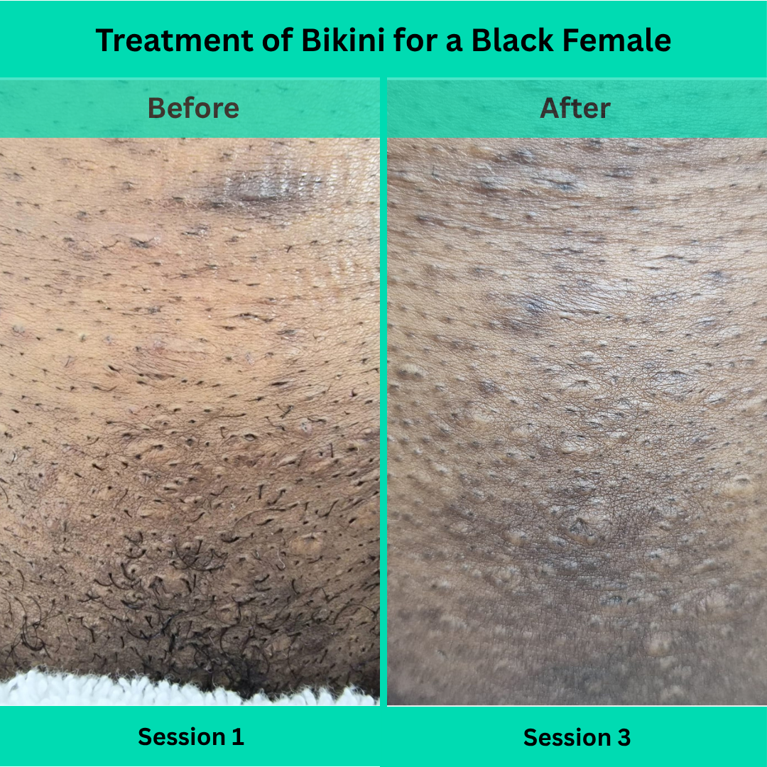 Before and After picture of Laser Hair Removal Treatment of Bikini for a Black Female